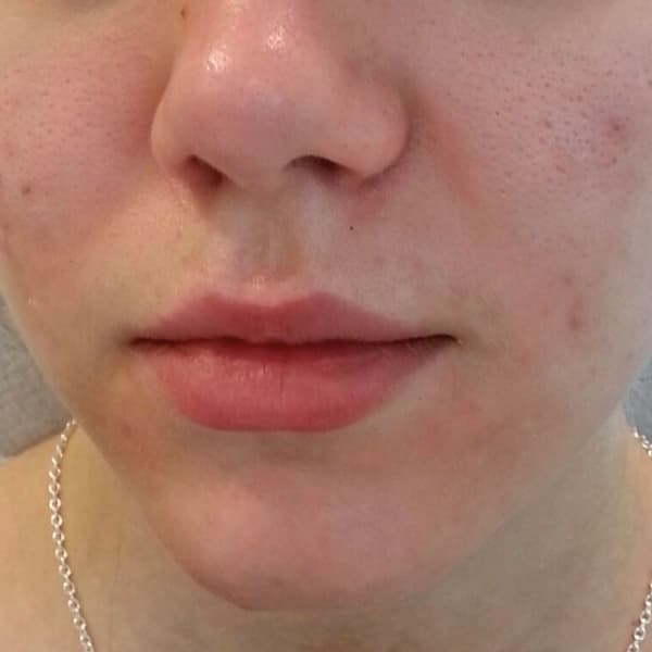 Green Peel Sonra - Cilt Problemi