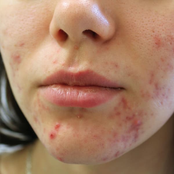 Green Peel Önce - Cilt Problemi